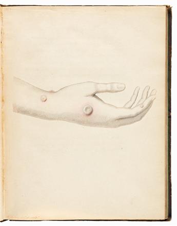 Jenner, Edward (1749-1823) On the Varieties and Modifications of the Vaccine Pustule, Occasioned by an Herpetic State of the Skin, Auth